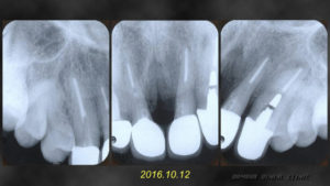 上顎の前歯にセラミックを用いた審美歯科治療を行う前のレントゲン写真